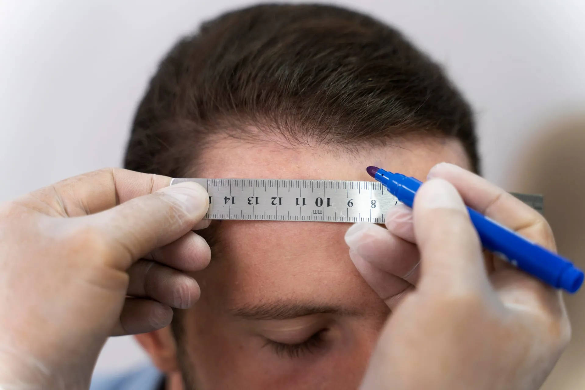 Voor de ingreep wordt de haarlijn met liniaal en pen opgemeten