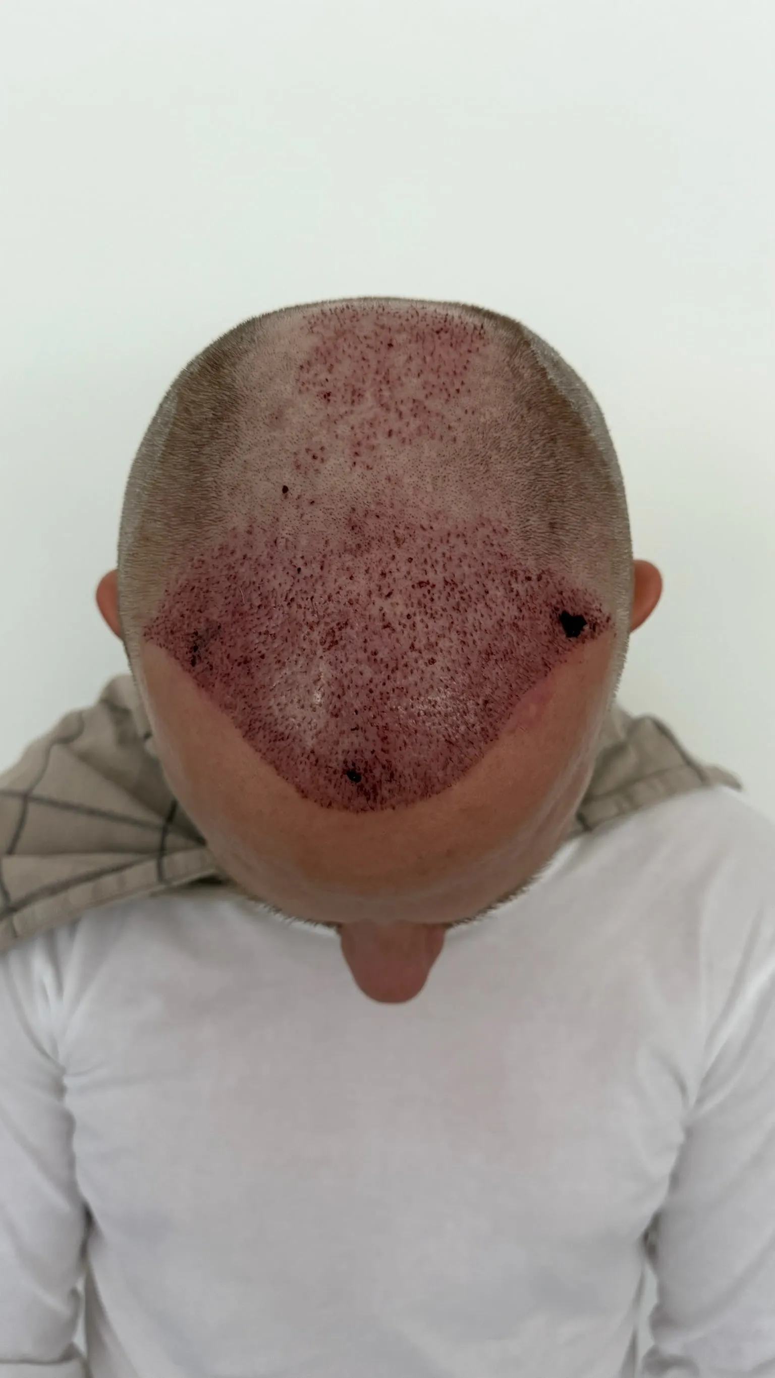 Hoofdhuid van bovenaf op dag 1 na de haartransplantatie