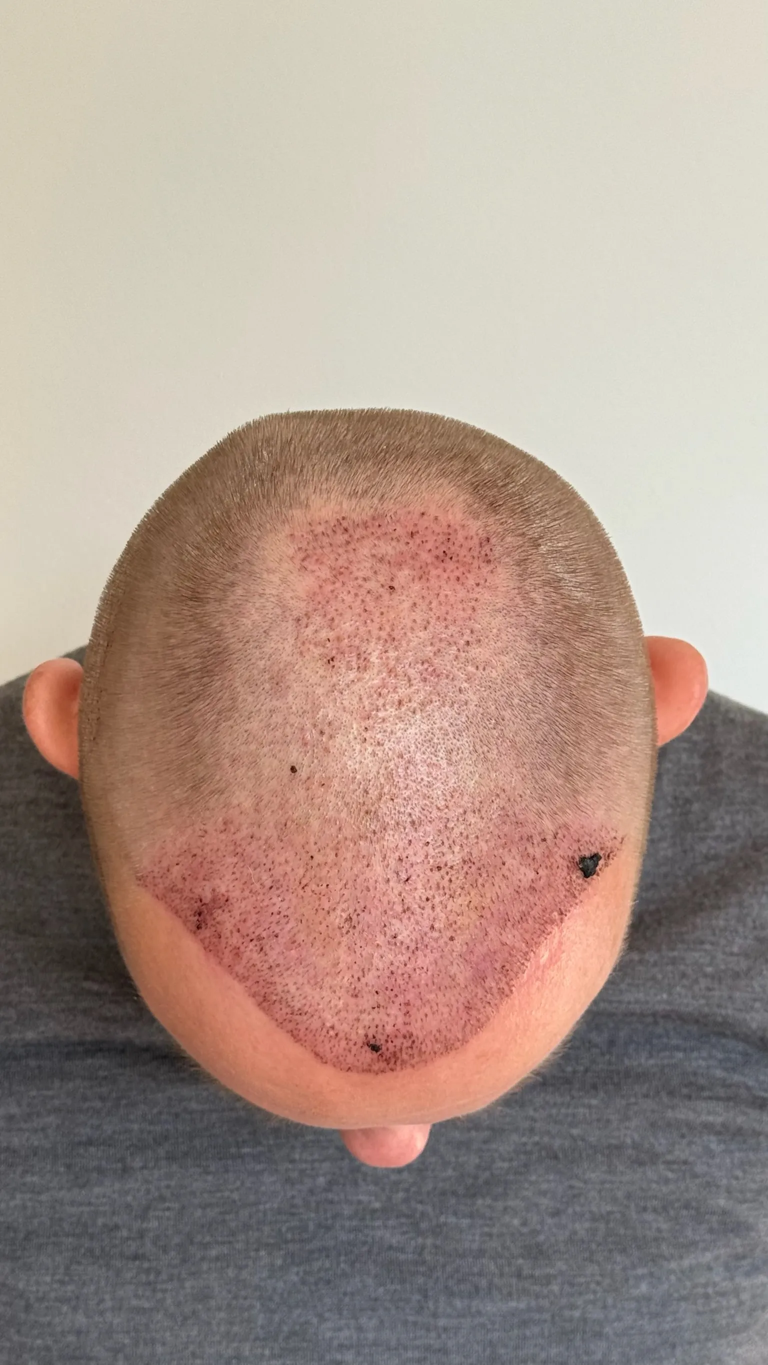 Hoofdhuid van bovenaf op dag 4 na de haartransplantatie