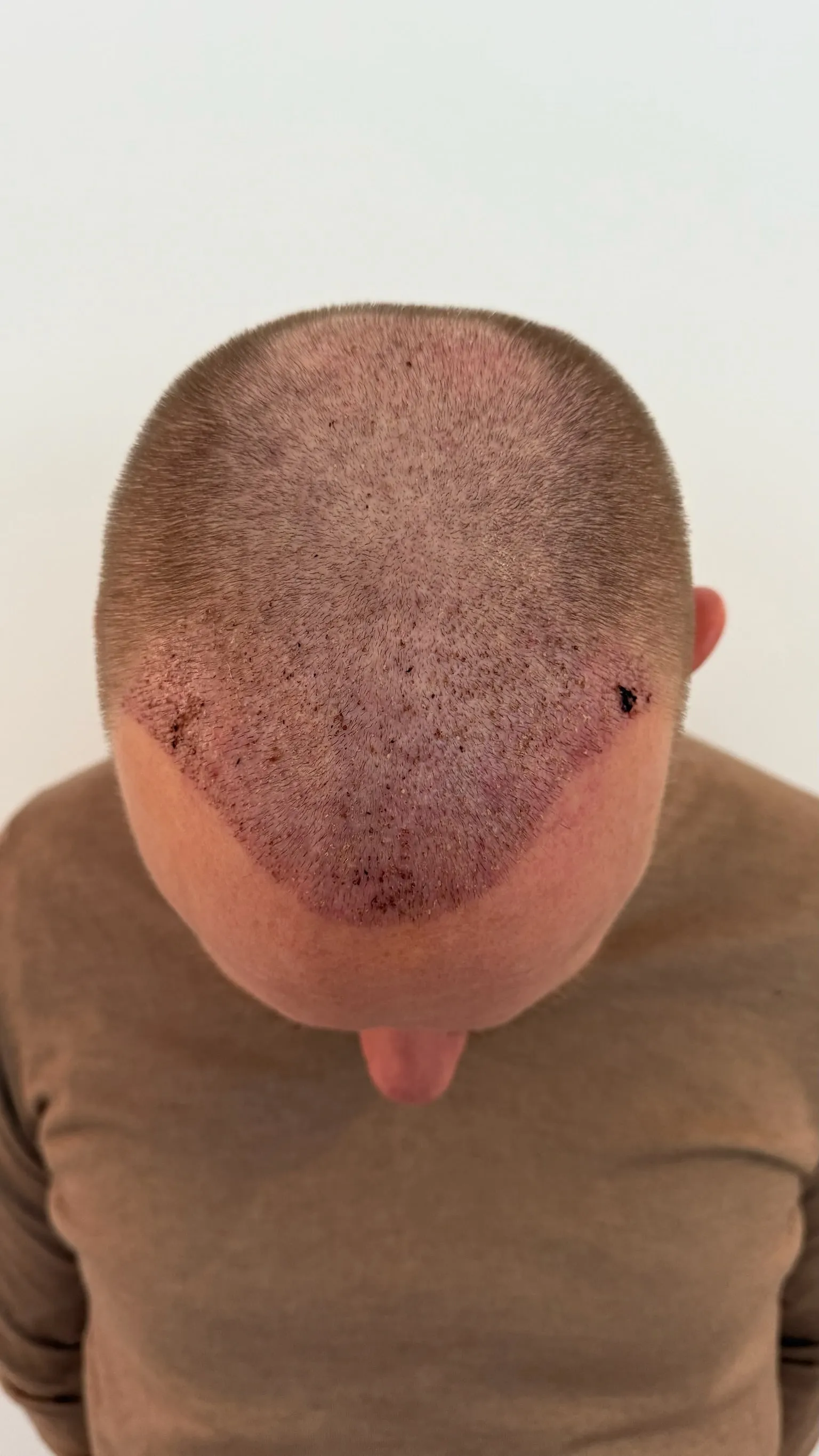 Hoofdhuid van bovenaf op dag 7 na de haartransplantatie