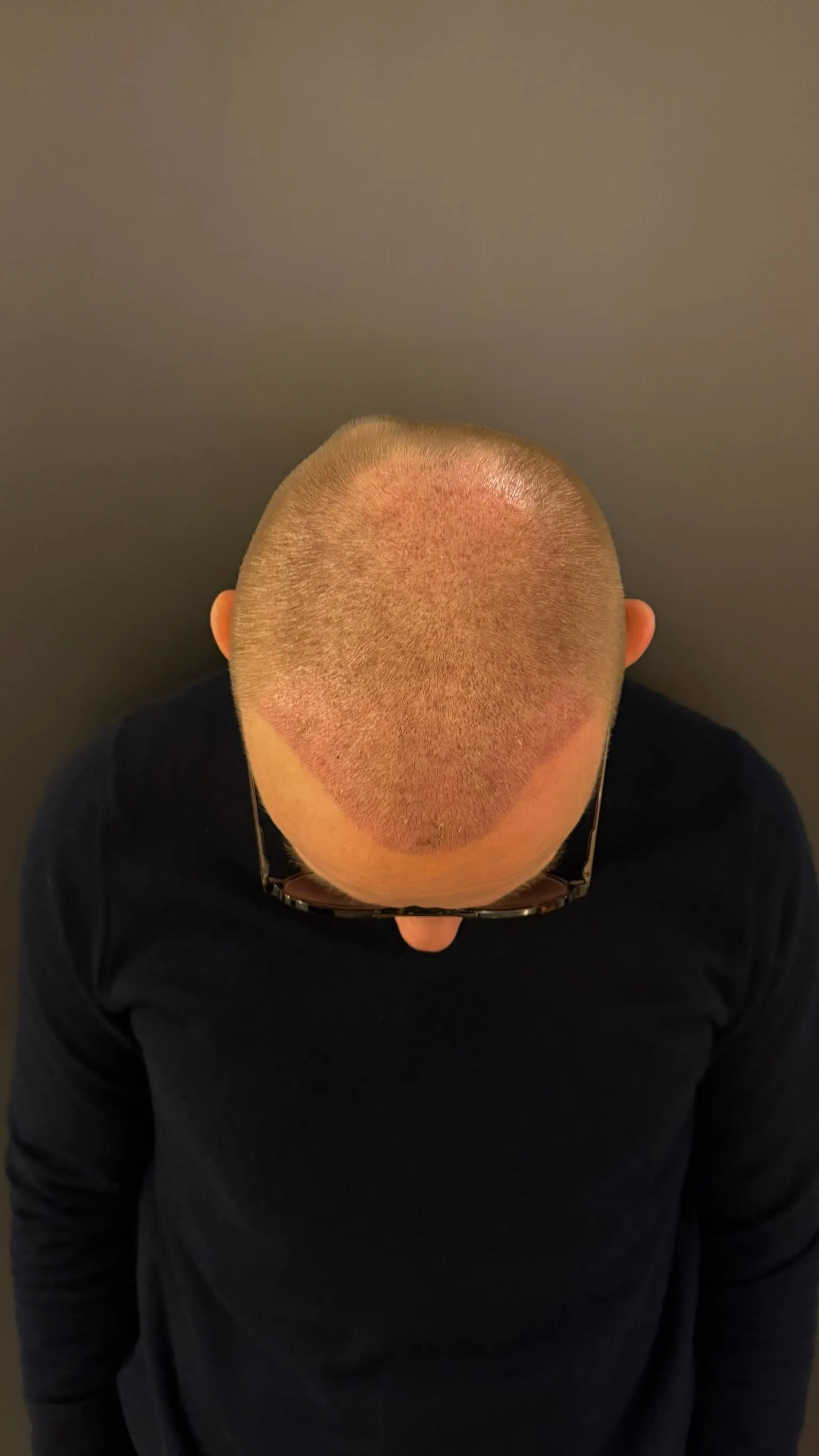 Hoofdhuid van bovenaf op dag 8 na de haartransplantatie